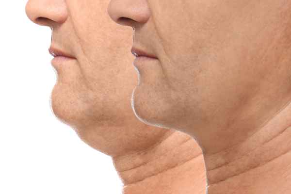 HIFU - Breakthrough in Anti - ageing 2 hifu results Brighton