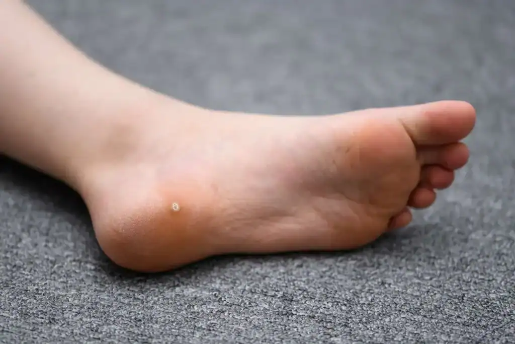 Cryotherapy For Warts And Also Verrucas 2 Image of verruca on the bottom of the foot that able to be treated with Cryotherapy Brighton