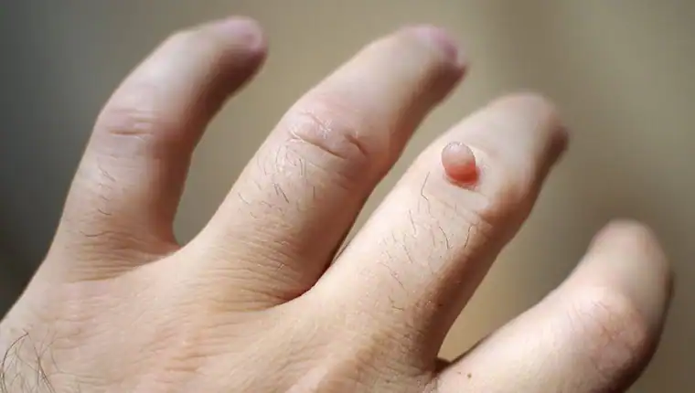 Cryotherapy For Warts And Also Verrucas 1 Image of blemish that Cryotherapy Brighton can remove with Lipo 360.