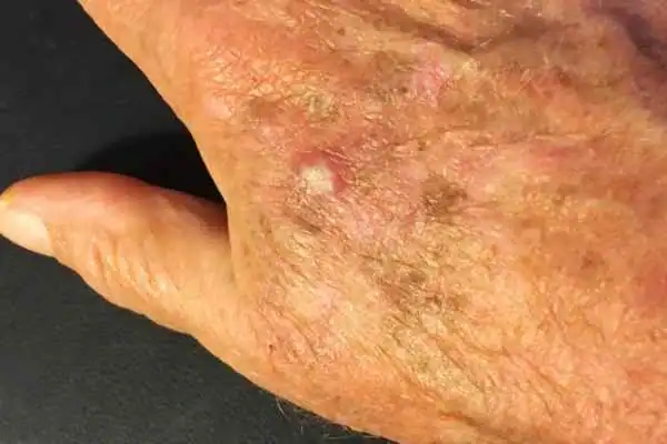 Cryopen For Actinic Keratoses 1 Image of Actinic keratoses Brighton on a person hand
